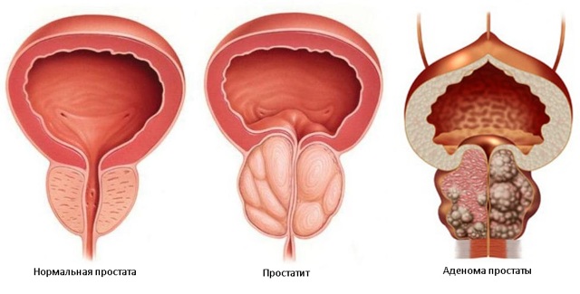 Нормальная простата, простатит, аденома простаты
